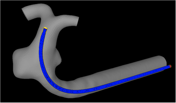 stent goes in